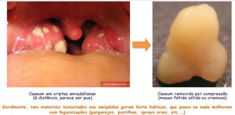 caseo-amigdalinao