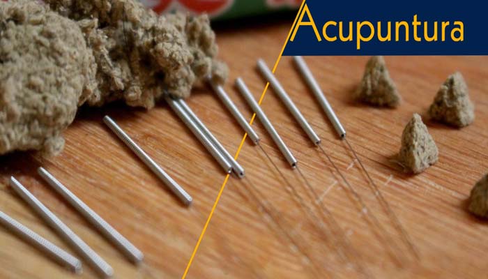 acupuntura