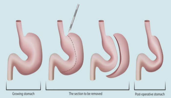 procedimentos-para-redução-de-estomago